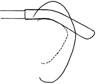 耳介の付け根の形状4