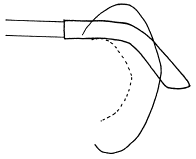 耳介の付け根の形状5